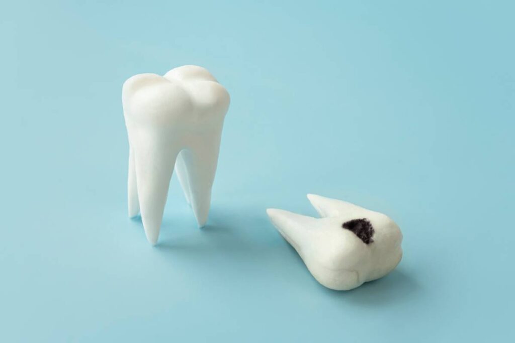 featured image for 3 foods to avoid after dental filling treatment